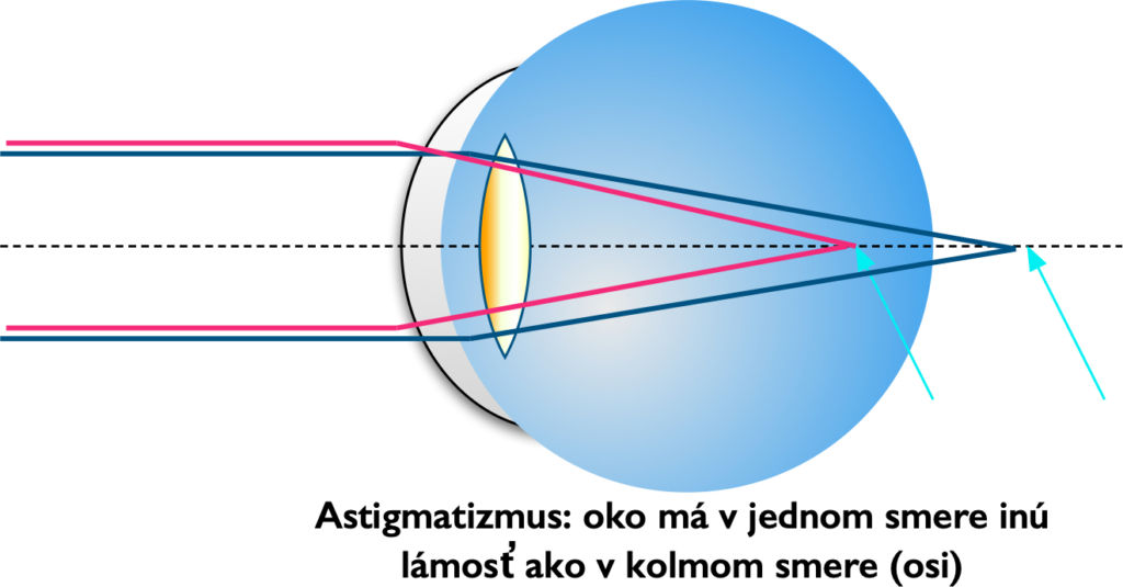 astigmatizmus