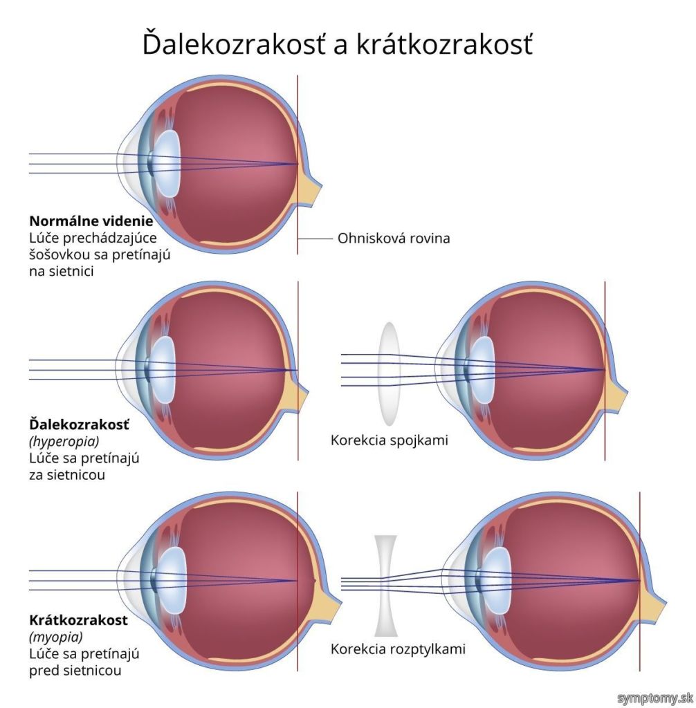 dioptrické okuliare